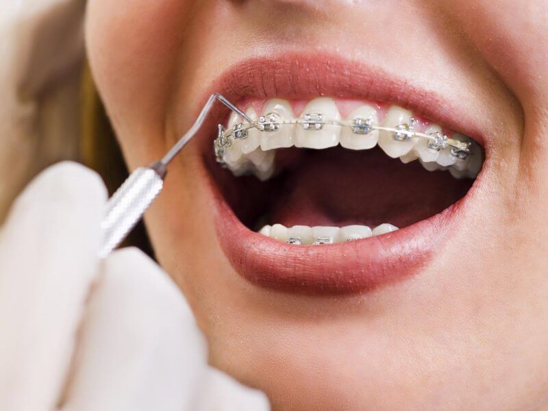 braces-treatment-vadodara